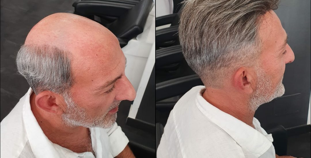 Protesi capelli Torino