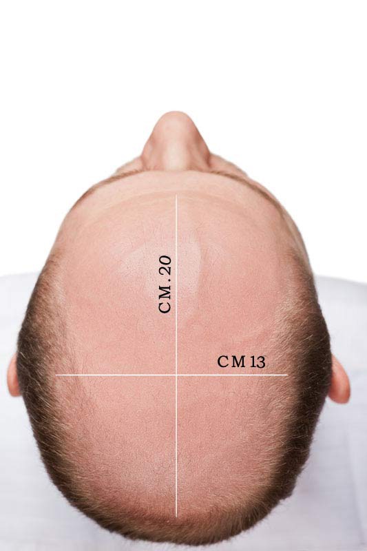 protesi capelli Genova protesi capelli Genova